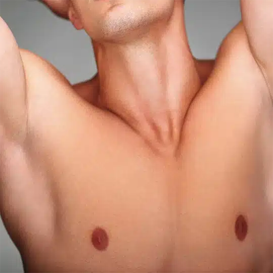 Breast Reduction for Men