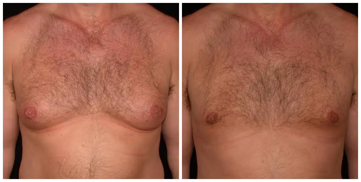 drvagotis - Breast Reduction for Men