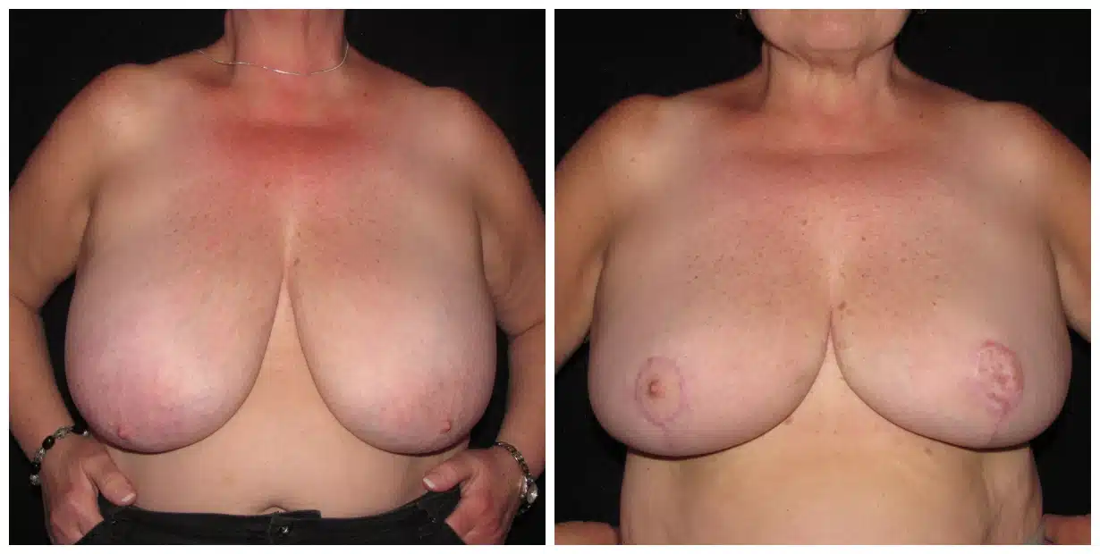 drvagotis - Breast Reduction