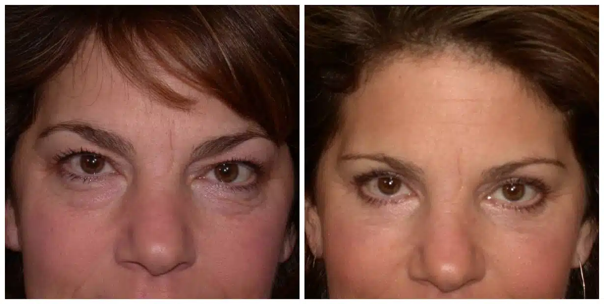 drvagotis - Eyelid Surgery - Facelift