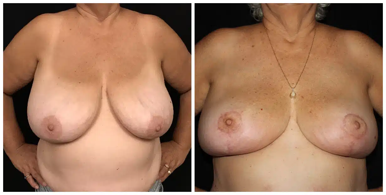 drvagotis - Breast Reduction