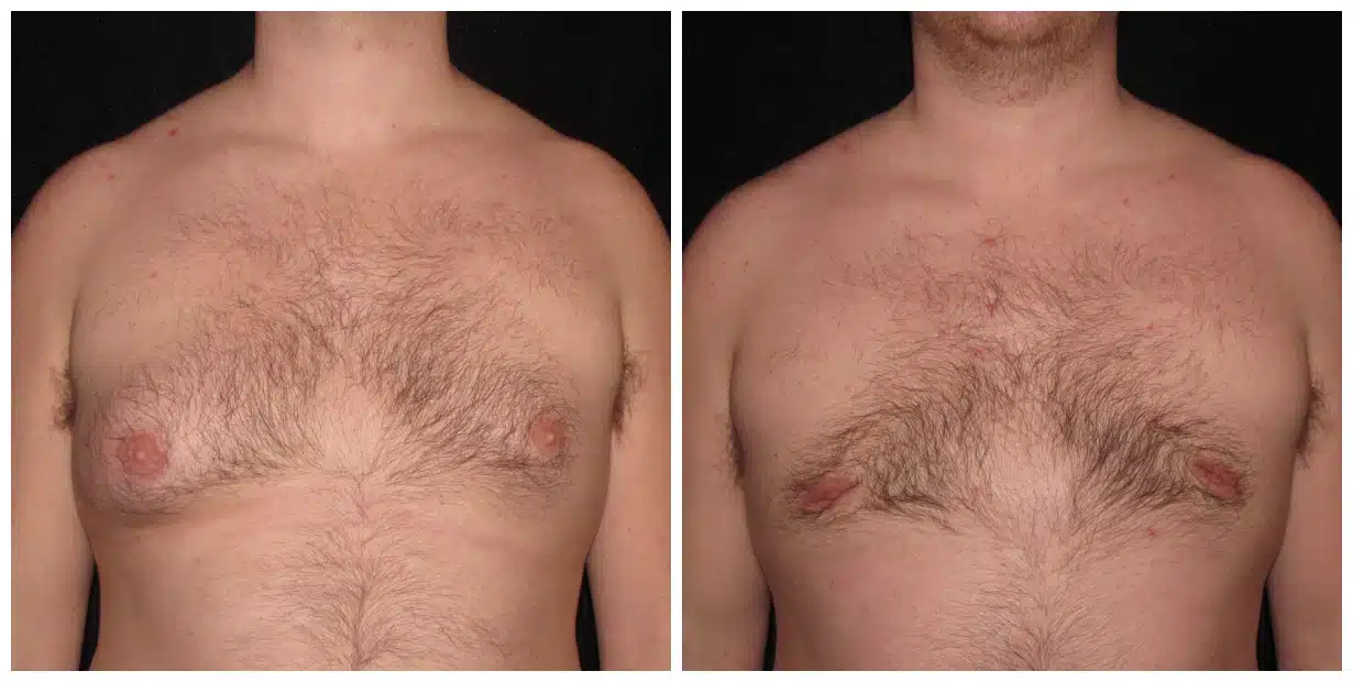 drvagotis - Breast Reduction for Men