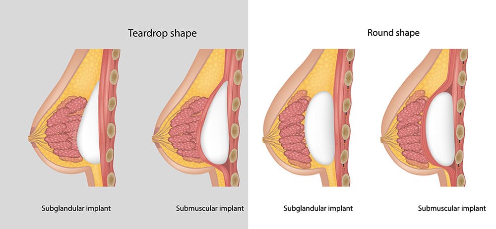 Gummy Bear Implants illustration