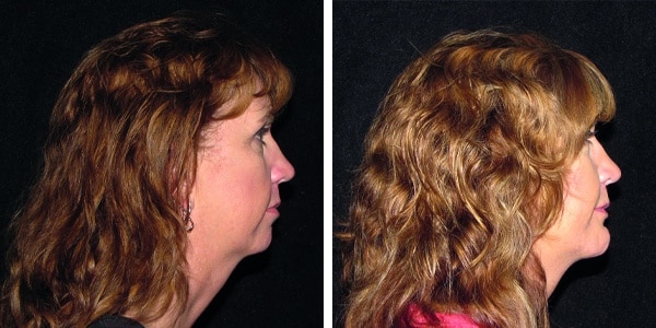 Before and after photo showcasing a woman's face transformation with chin augmentation.