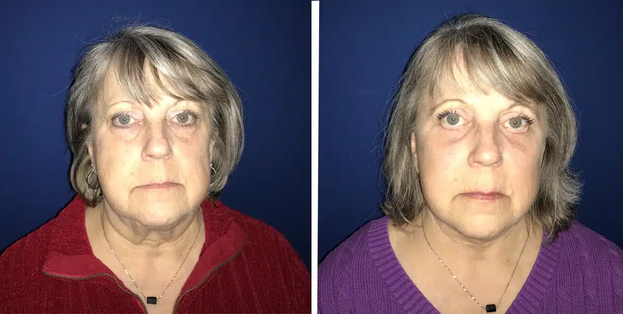 A woman's face before and after cosmetic facial surgery.