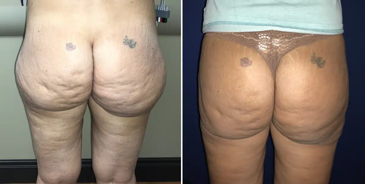 Before and after photo of a woman's butt following liposuction.