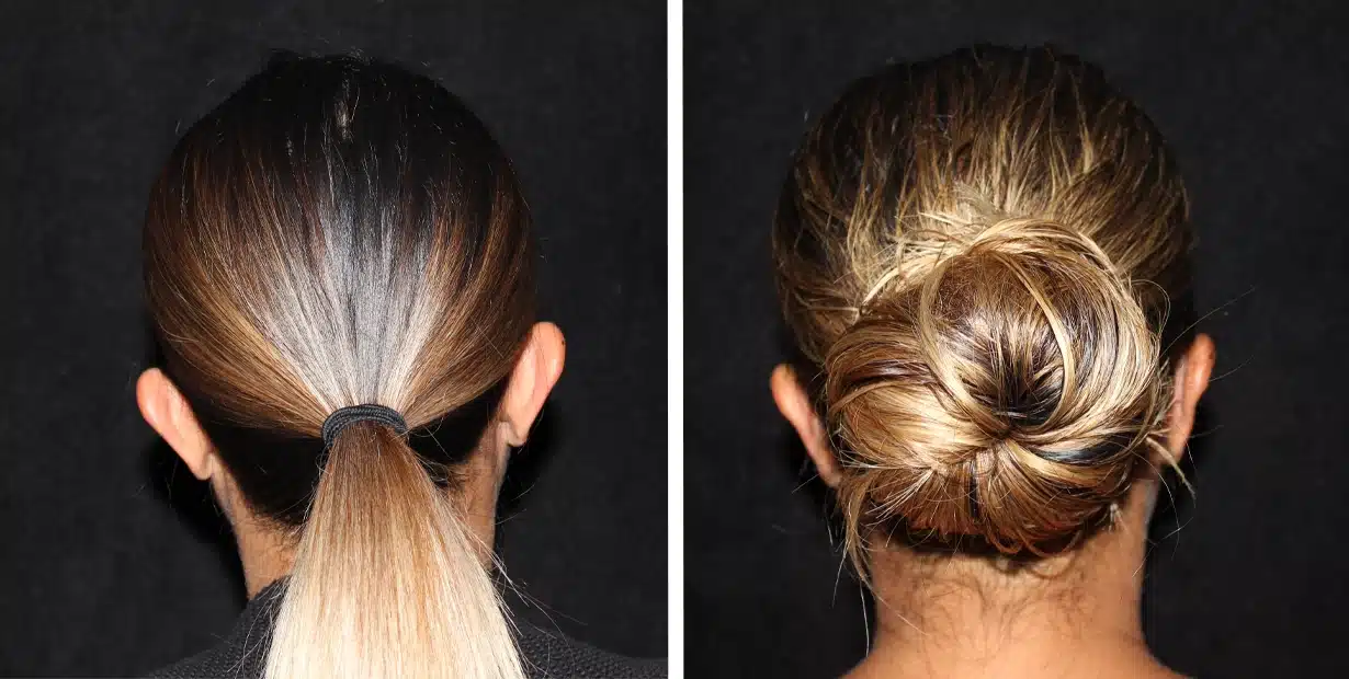 Two pictures of a woman with her hair in a ponytail showcasing otoplasty results.