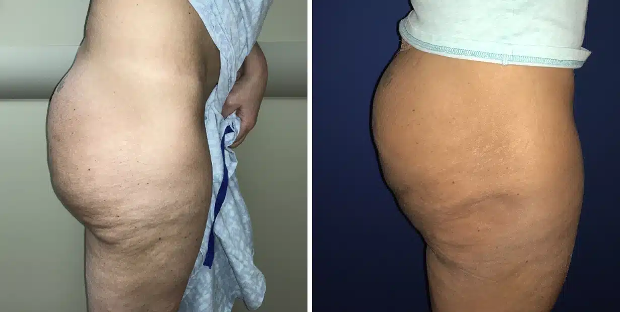 Before and after photo showcasing the dramatic effects of liposuction on a woman's thigh.