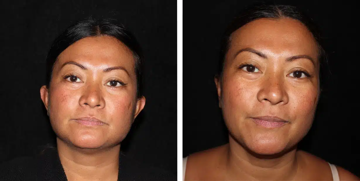 A woman's face before and after liposuction and otoplasty.