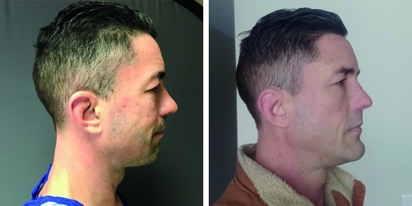 Before and after photos of a man with chin augmentation.