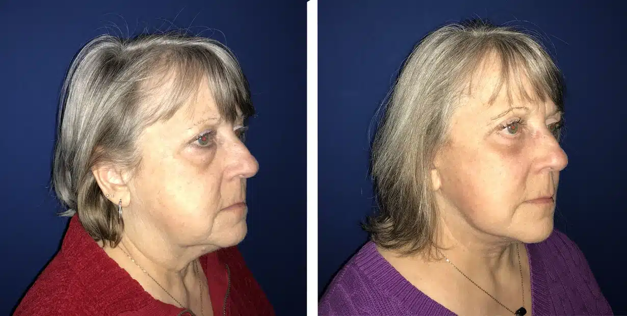 Photographic documentation of a woman undergoing a remarkable face lift transformation.