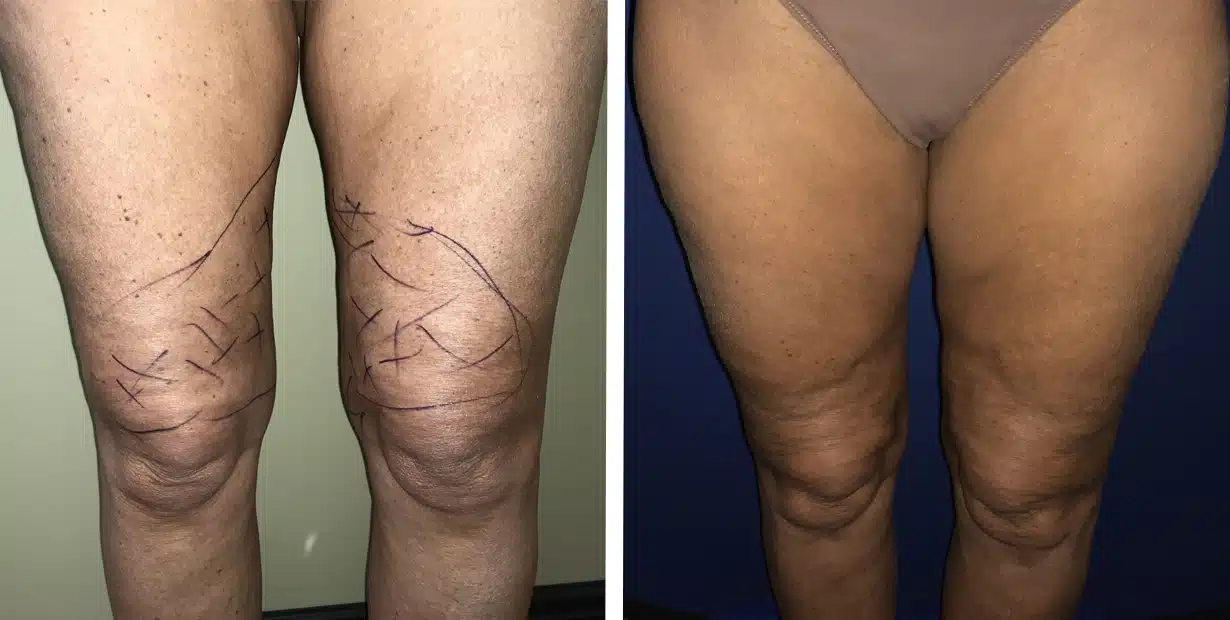 Before and after liposuction photo of a woman's legs.