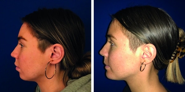 Before and after photos of a woman's rhinoplasty, including chin augmentation.