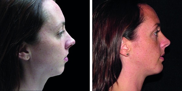 A woman's face before and after liposuction and chin augmentation.