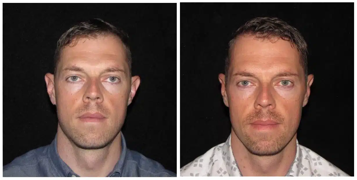 Before and after pictures of a man's face following otoplasty.