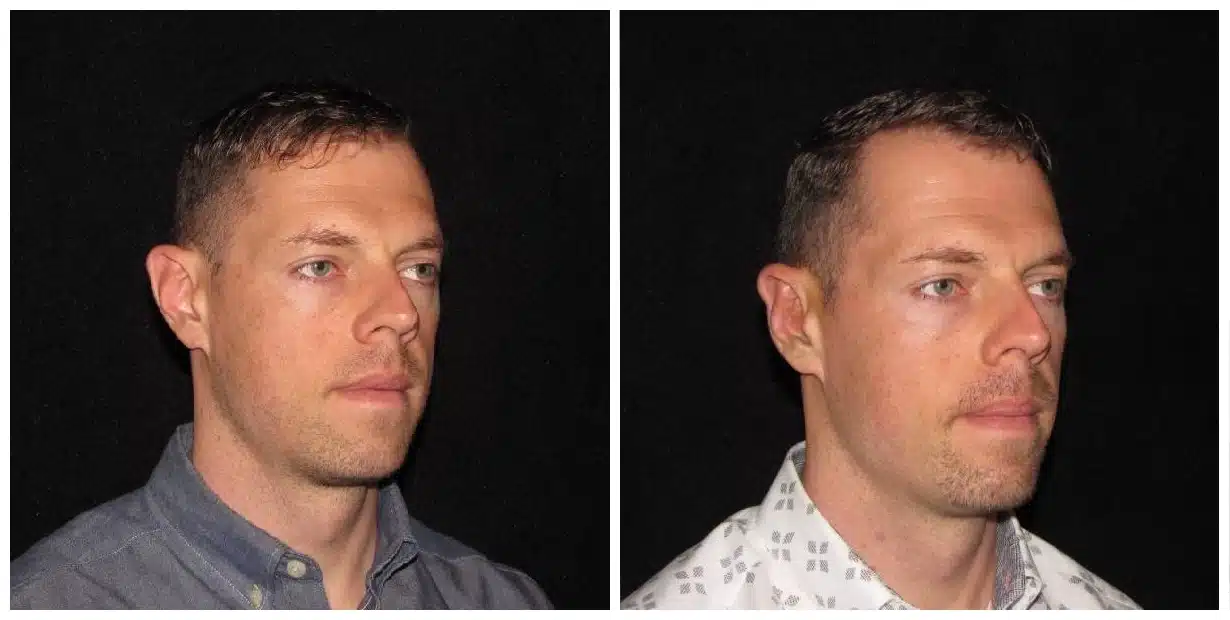 Before and after pictures of a man's face following otoplasty.