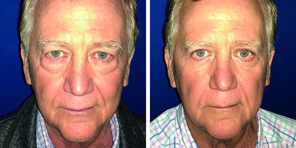 Before and after photos showcasing a man's transformative face lift.