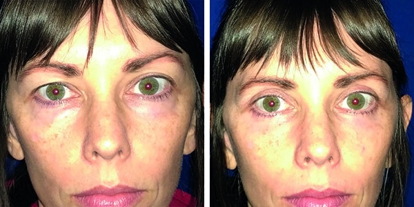Before and after photos of a woman's face post-eye surgery.
