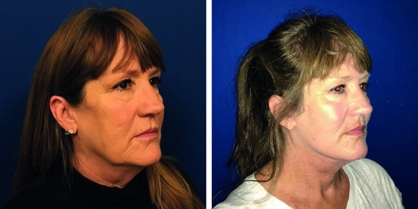A woman's face after rhinoplasty, enhancing the nose.