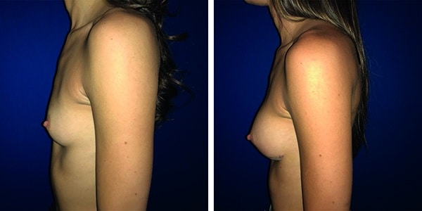 Before and after breast augmentation surgery.