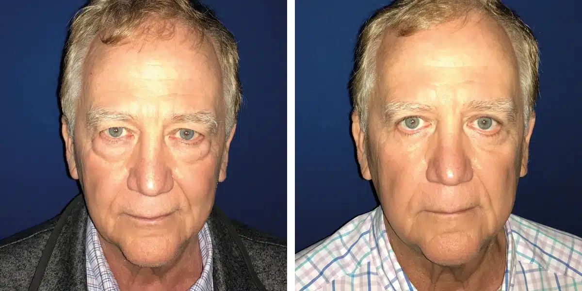 A man's face before and after eyelid surgery.