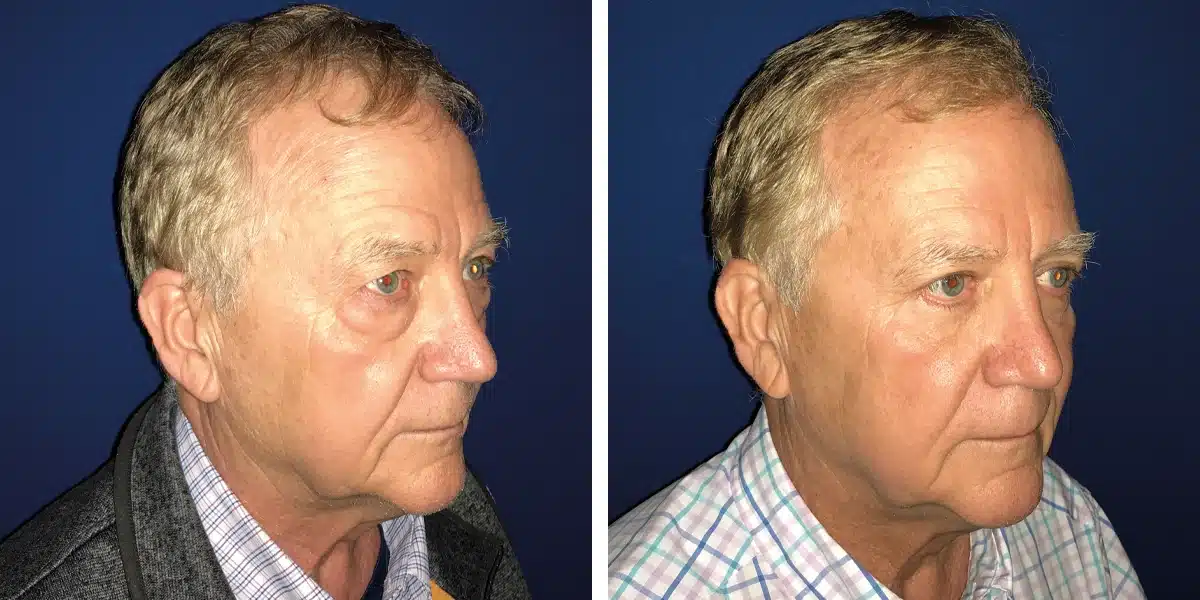 Before and after eyelid surgery photos of a man's face.
