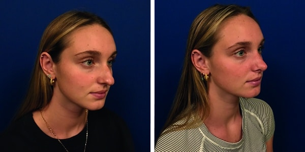 Nose reshaping before and after.