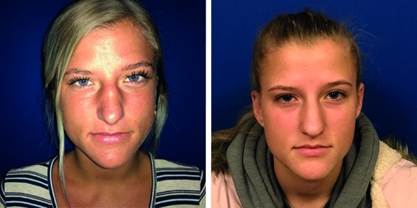 Before and after photos of nose reshaping through rhinoplasty.