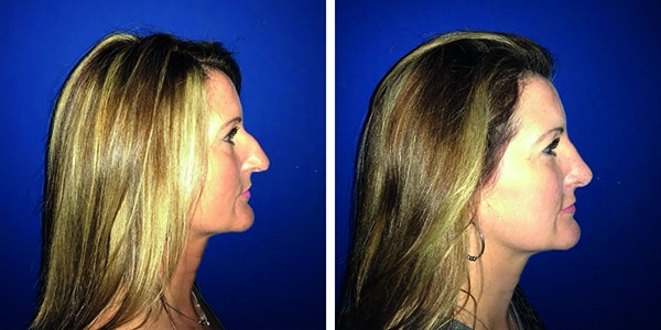 Nose reshaping transformation through rhinoplasty.