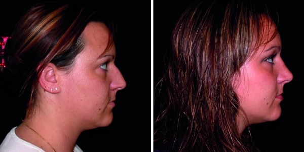 Before and after photos showcasing nose reshaping through rhinoplasty.