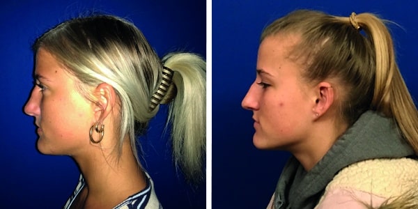 Before and after photos showcasing nose reshaping through rhinoplasty.
