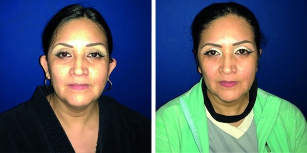Before and after photos of a woman's face post Otoplasty.
