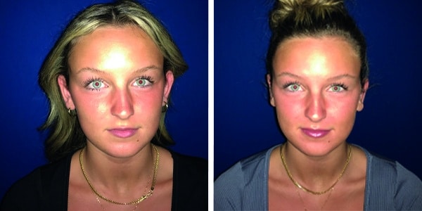 A woman's face before and after rhinoplasty.