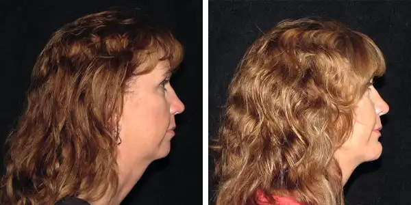 Before and after photos of a woman's face showcasing chin augmentation.