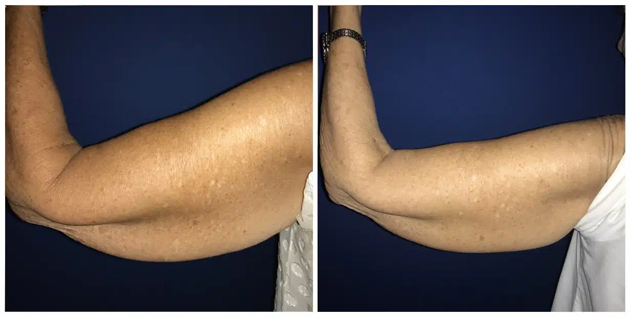 A woman's arm before and after brachioplasty, a procedure that improves upper arm appearance.