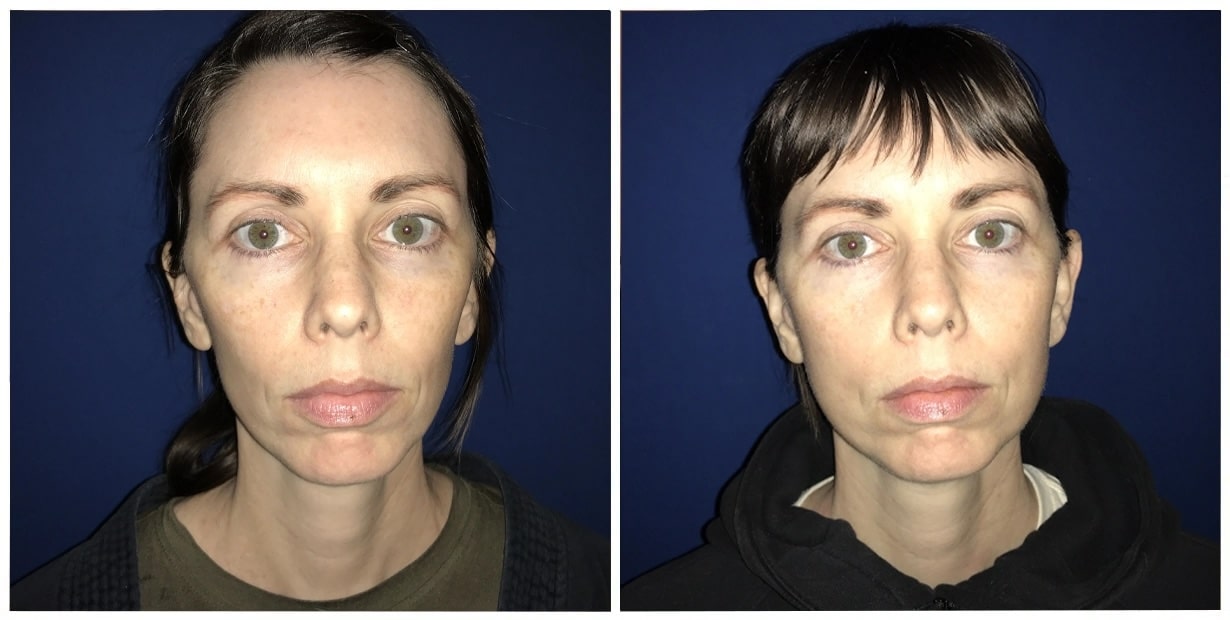 A woman's face before and after liposuction with fat grafting.