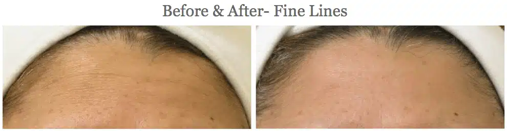 A woman's skin is shown before and after a fine lines treatment.