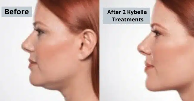 A woman's face before and after kybella treatments.