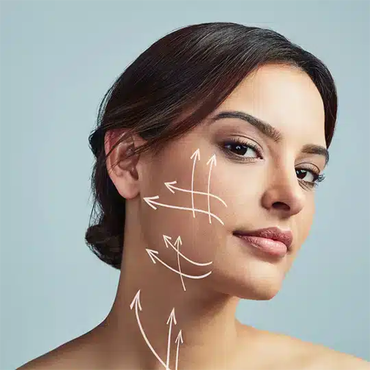 Woman with arrows on face and neck indicating facelift directions.