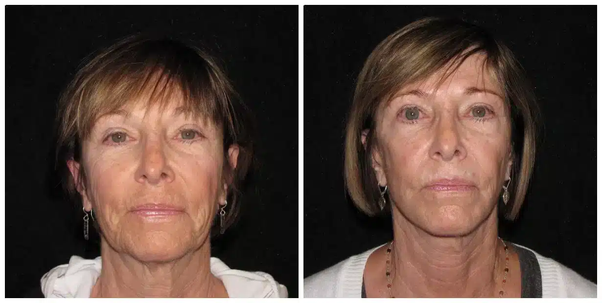 Before and after comparison of a woman's facial appearance following a facelift.