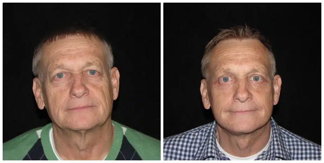 Before and after images of a man, possibly demonstrating the results of a facelift.