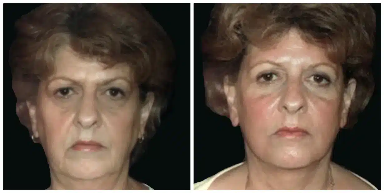 Before and after comparison of a woman's facial appearance following a facelift.