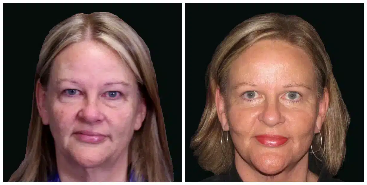 Before and after comparison of a woman's facial appearance, possibly following a facelift or makeup application.