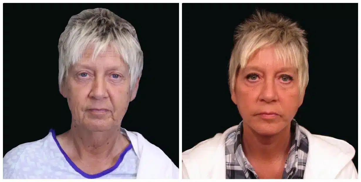 Before and after comparison of a woman's hairstyle, makeup transformation, and facelift.