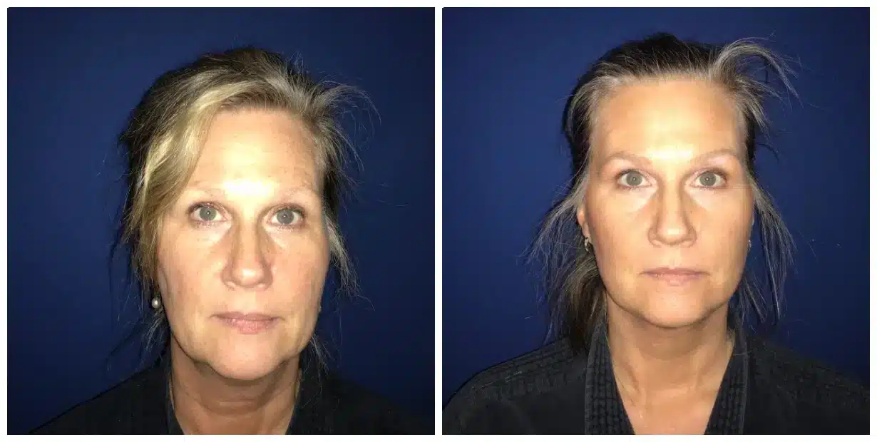 Side-by-side comparison of a woman before and after a facelift with two different facial expressions against a blue background.