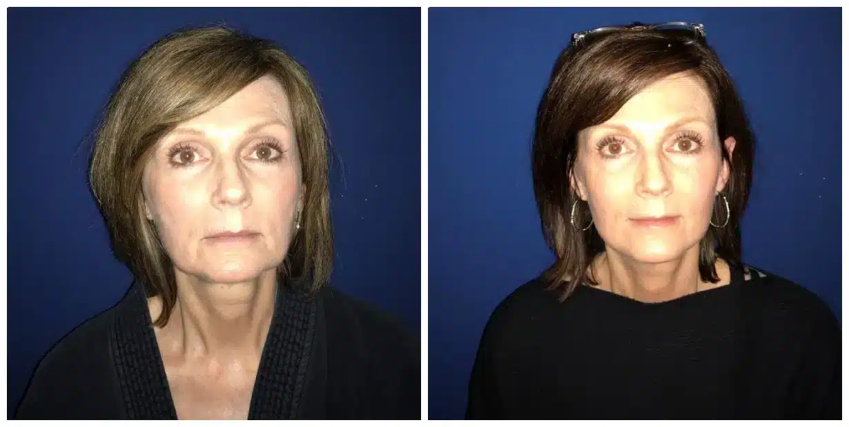 Comparison of a woman without makeup on the left and with a facelift effect achieved through makeup on the right against a blue background.