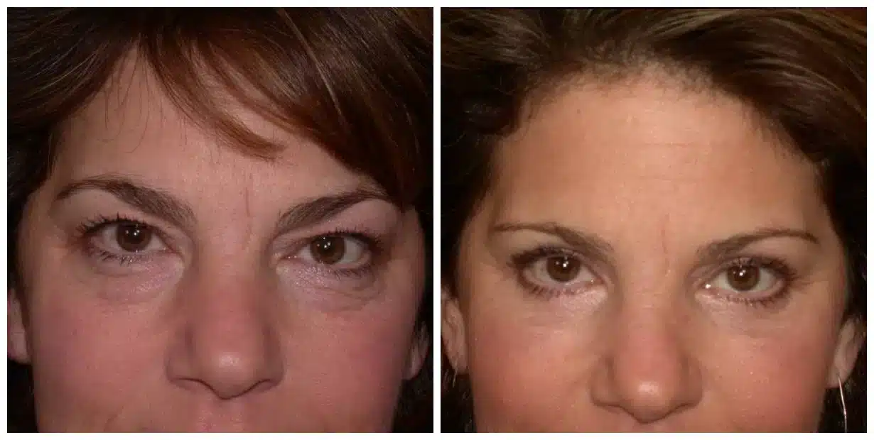 Before and after comparison of a woman's under-eye area following a facelift.