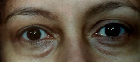 Blepharoplasty case #119729