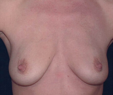 Breast Lift w/ Implants case #119693