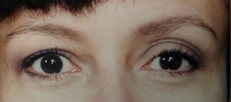 Blepharoplasty case #119729